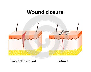 Wound healing process with help surgical suture. photo