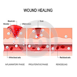 Wound healing process. Tissue injury and inflammation