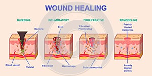 Wound healing process vector illustration