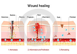 Wound healing. Stages of the post-trauma repairing process