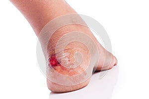 Wound at heel