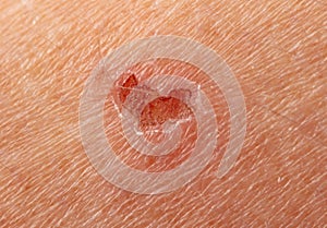 Wound on human skin. Macro