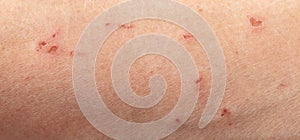 Wound on human skin. Macro