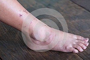 Wound leg, Diabetic foot syndrome.