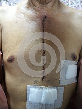 Wound scar after heart attack operation on patient chest , heart surgery scar