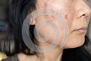 Wound scar on a woman\'s face as a result of laser treatment. The concept of beauty and skin treatment.
