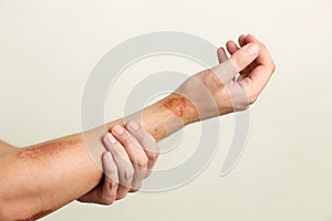 Wounds on man's arm