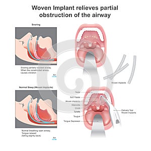 Woven Implant relieves partial obstruction of the airway.