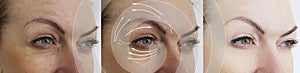 Wrinkle eye wrinkles before and after difference treatment cosmetology