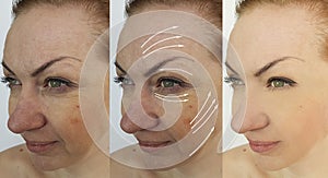 Wrinkle eye wrinkles before and after treatment