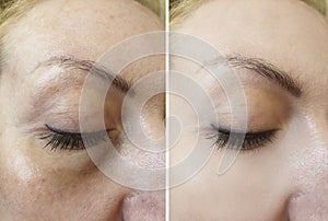 Wrinkle eye wrinkles before  after treatment patient