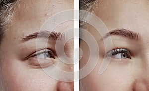 Wrinkle girl before and after procedures difference, correction