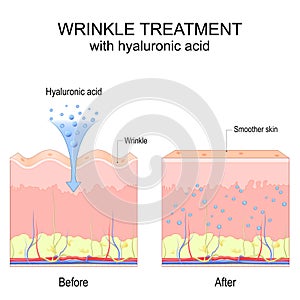 Wrinkle treatment with hyaluronic acid