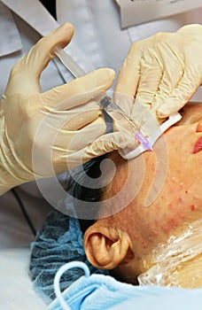 Wrinkle treatment injecting