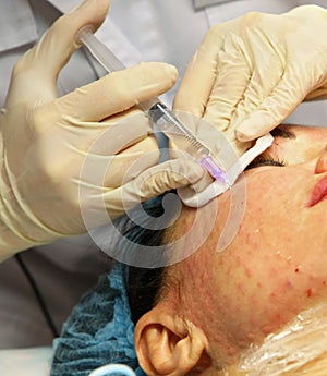 Wrinkle treatment injecting