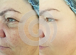 Wrinkle woman face before after difference treatment removal of rosacea