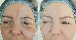 Wrinkle woman face before  after treatment  removal  of rosacea