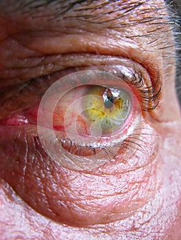 Wrinkled bloodshot eye