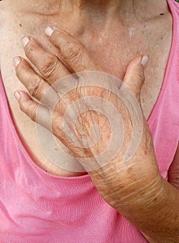 Wrinkled hands of old woman, fingers affected by arthritis