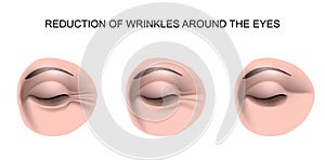 Wrinkles around the eyes photo
