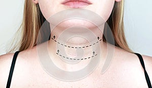 A cosmetologist prepares the patient for surgery: contour plastics of the neck, mesotherapy or botulinum therapy. Wrinkles and