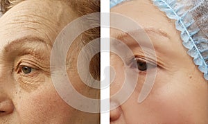 Wrinkles elderly woman face before and after cosmetic procedures, therapy, anti-aging