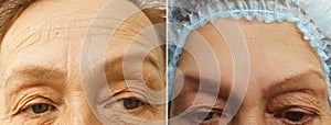 Wrinkles elderly woman face effect collagen hydrating health correction before and after cosmetic procedures, therapy, anti-aging