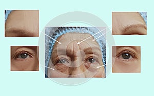 Wrinkles elderly woman face effect collagen hydrating health correction before and after cosmetic procedures, therapy, anti-aging