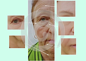 Wrinkles elderly woman face effect rejuvenation health correction before and after cosmetic procedures, therapy, anti-aging