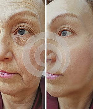 Wrinkles elderly woman face hydrating correction before and after cosmetic procedures, therapy, anti-aging