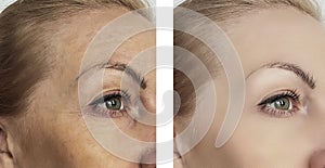 wrinkles eyes before and after procedures, correction bloating, bags