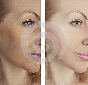 Wrinkles eyes before and after procedures, lifting correction bloating, bags