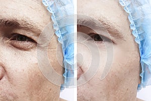 Wrinkles face bags man before and after therapy difference effect treatments