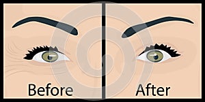 Wrinkles and fine lines under eyes to remove. Before and After. Eyes lifting