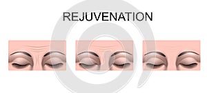 Wrinkles on the forehead. rejuvenation. plastic surgery