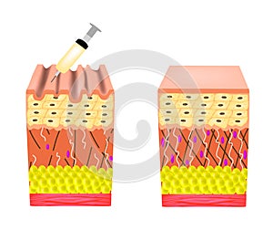 Wrinkles on the skin. Botox wrinkle treatment. Anatomical skin structure. Botox injection. Infographics. Vector