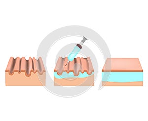 Wrinkles on the skin. Botox wrinkle treatment. Anatomical skin structure. Botox injection. Infographics. Vector