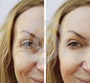 wrinkles and woman before and after rejuvenation