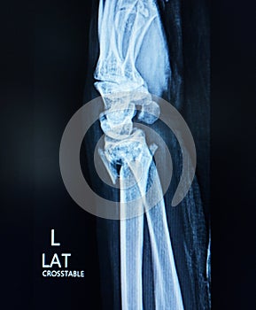 Wrist and hand x-ray PA view showing intra-articular comminuted fracture distal radius. Medical image concept.