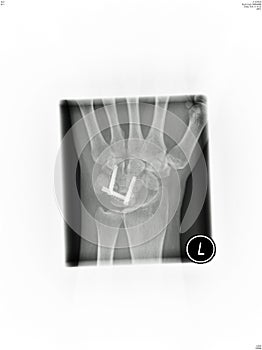 Wrist x-ray