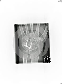 Wrist x-ray photo