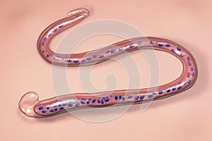 Wuchereria bancrofti, a roundworm nematode, one of the causative agents of lymphatic filariasis