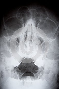 X ray