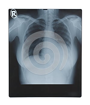 X-ray