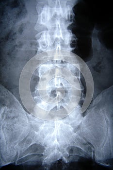 X-ray