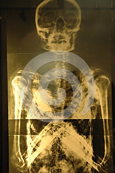 X ray