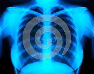 X-ray