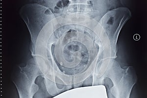 X-ray