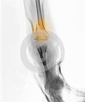 X-ray, 4 year old boy, fracture of distal humerus photo