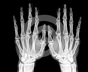 X ray